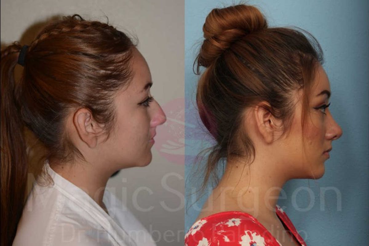 Rhinoplasty Before & After Gallery - Patient 133182403 - Image 5