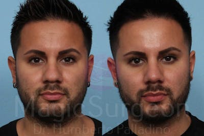 Rhinoplasty Before & After Gallery - Patient 133182406 - Image 1