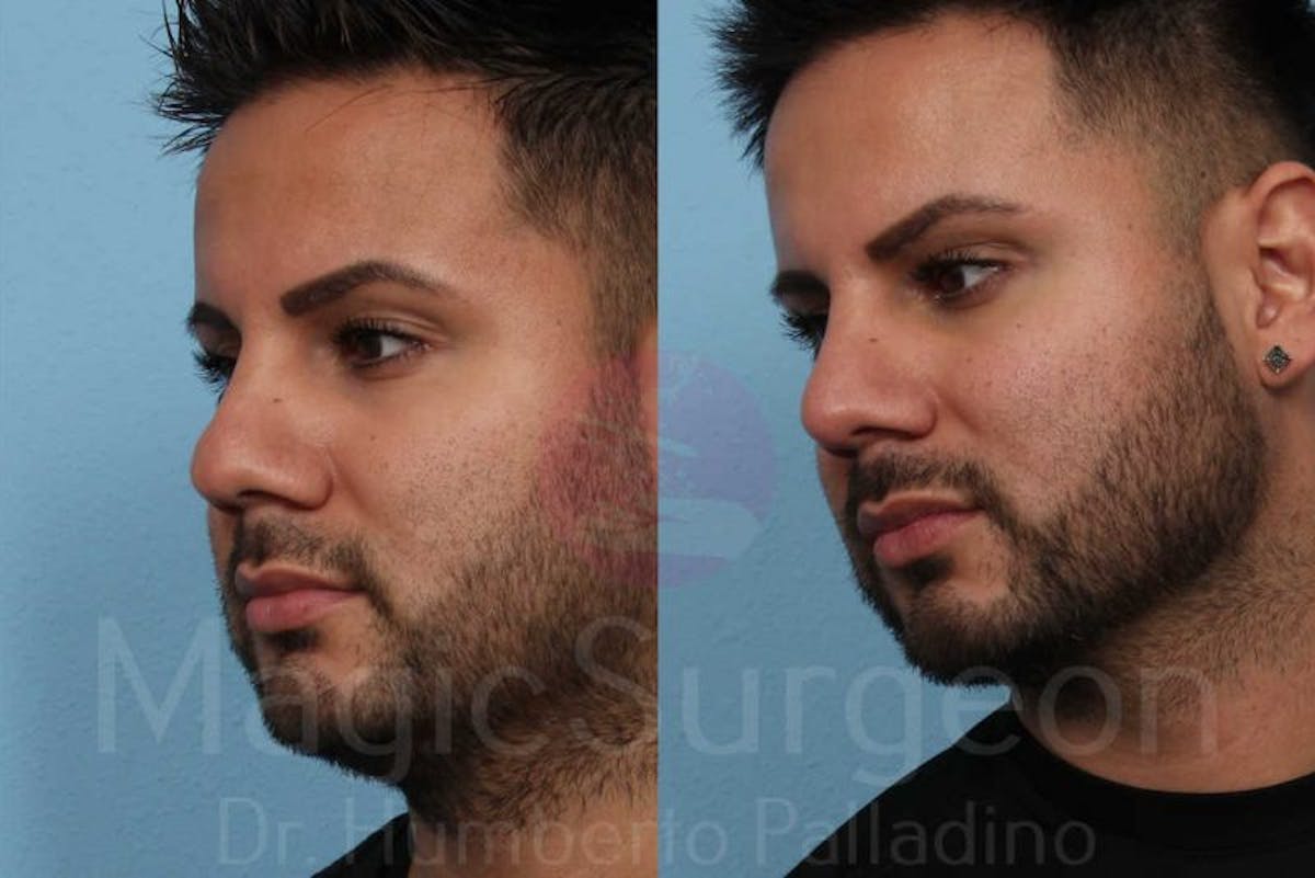 Rhinoplasty Before & After Gallery - Patient 133182406 - Image 2