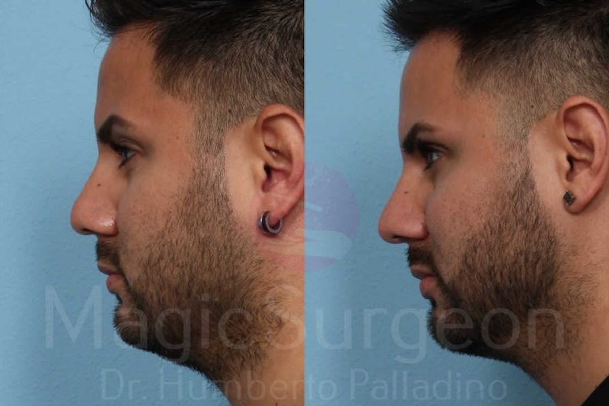 Rhinoplasty Before & After Gallery - Patient 133182406 - Image 3