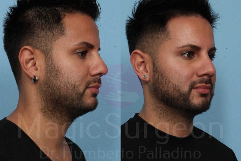 Rhinoplasty Before & After Gallery - Patient 133182406 - Image 4