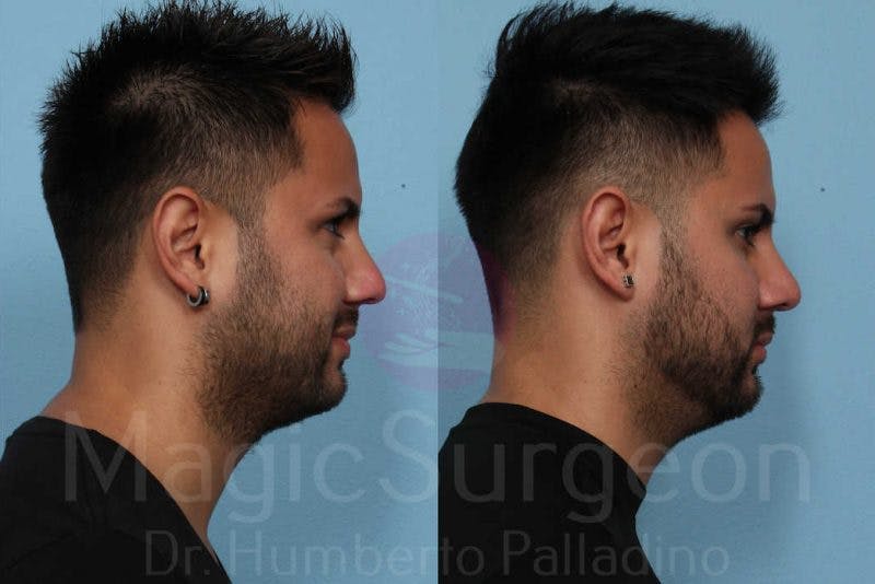 Rhinoplasty Before & After Gallery - Patient 133182406 - Image 5