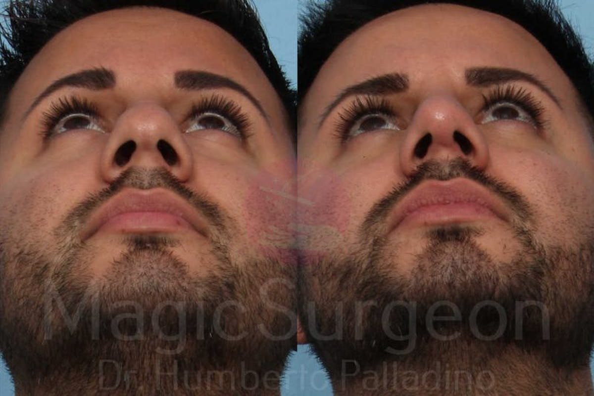 Rhinoplasty Before & After Gallery - Patient 133182406 - Image 6