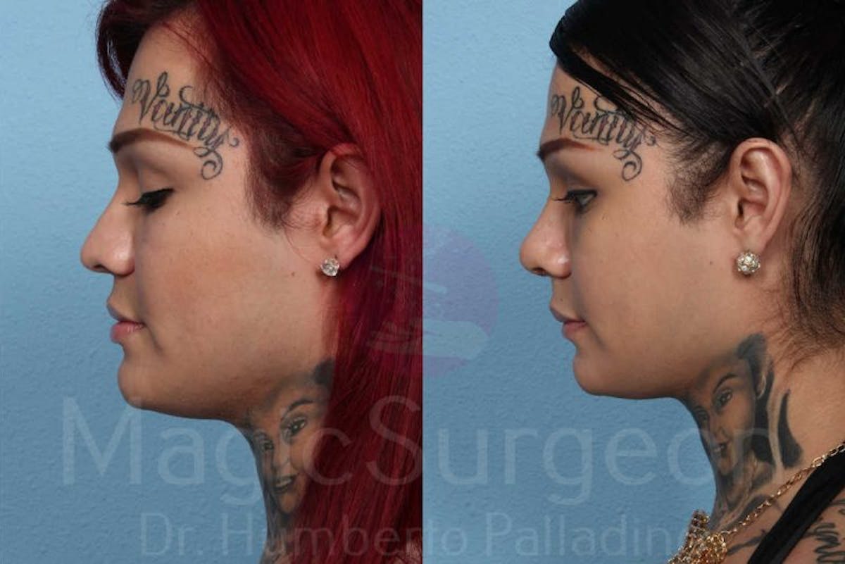 Rhinoplasty Before & After Gallery - Patient 133182407 - Image 3