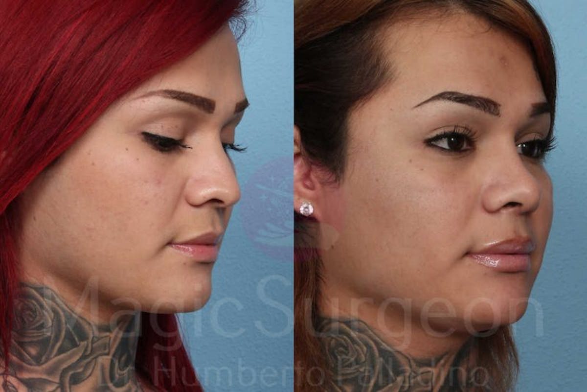 Rhinoplasty Before & After Gallery - Patient 133182407 - Image 4