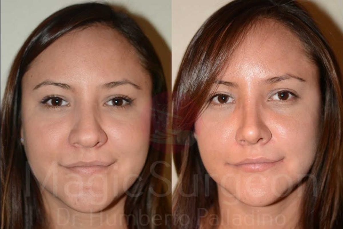 Rhinoplasty Before & After Gallery - Patient 133182409 - Image 1