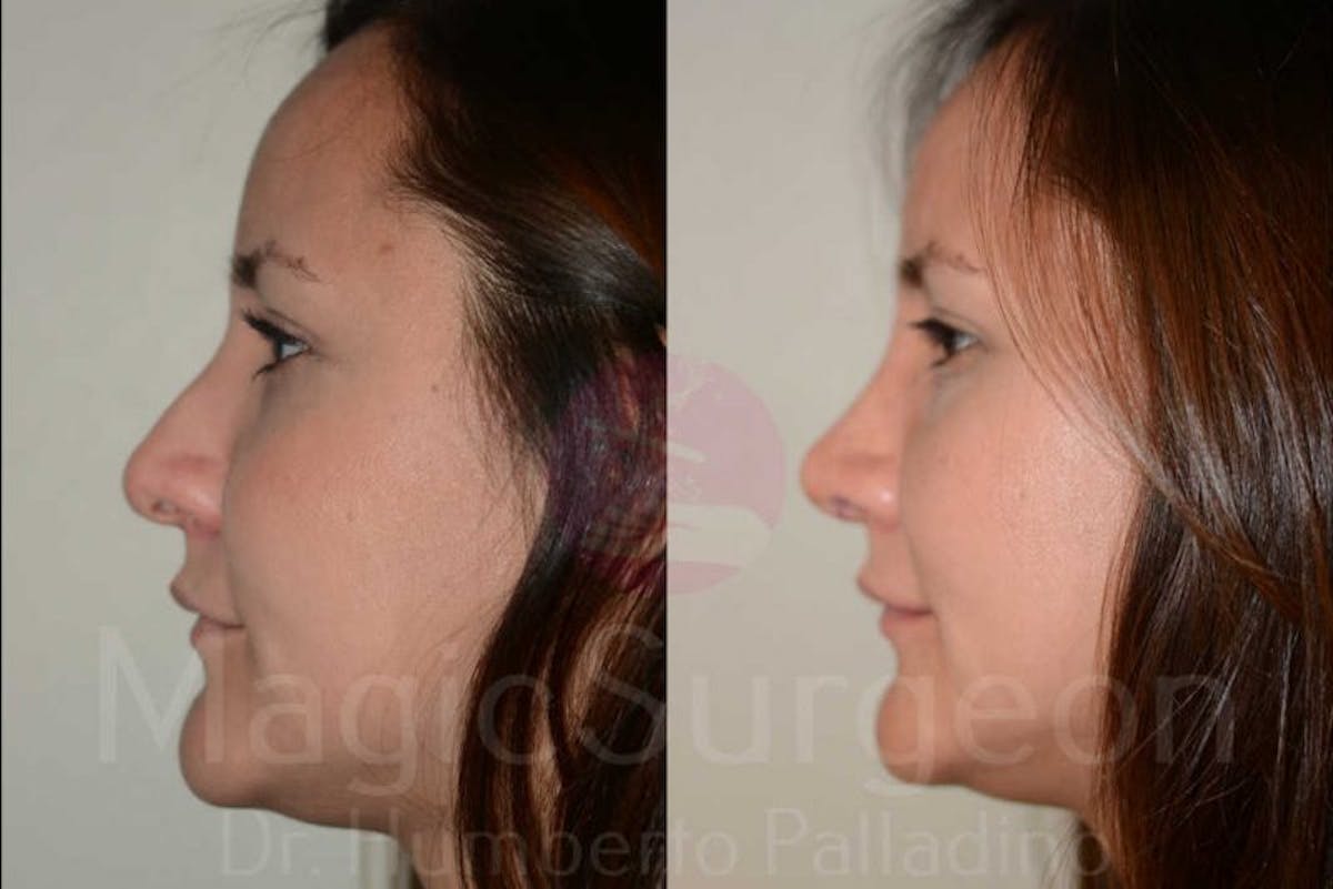 Rhinoplasty Before & After Gallery - Patient 133182409 - Image 2