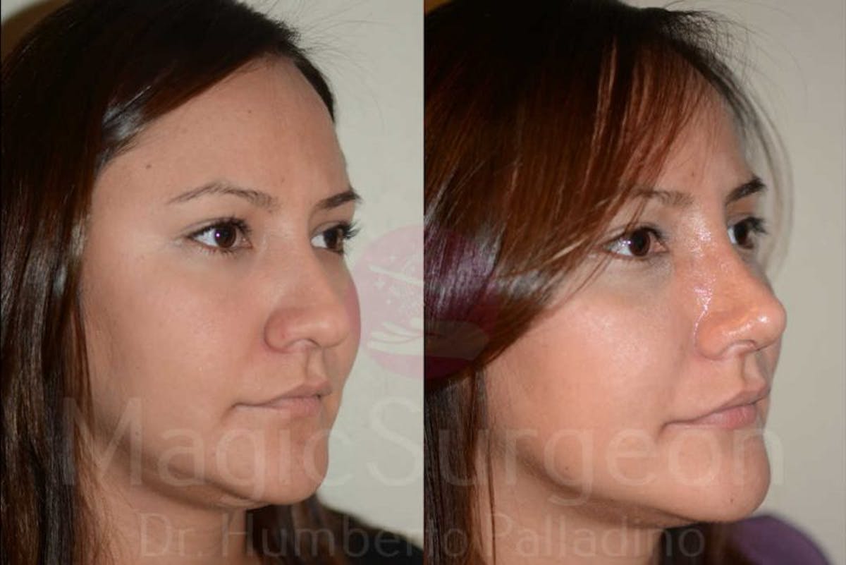 Rhinoplasty Before & After Gallery - Patient 133182409 - Image 3