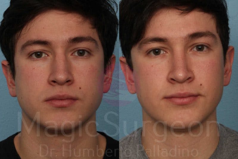 Rhinoplasty Before & After Gallery - Patient 133182411 - Image 1