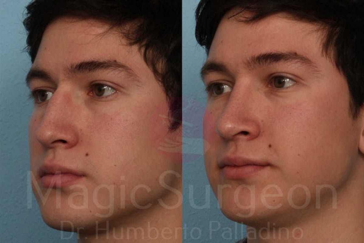 Rhinoplasty Before & After Gallery - Patient 133182411 - Image 2