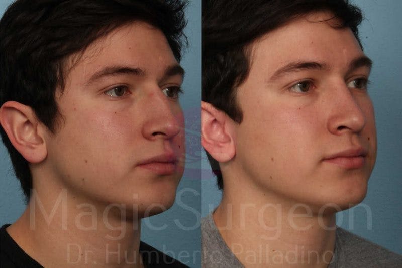 Rhinoplasty Before & After Gallery - Patient 133182411 - Image 4