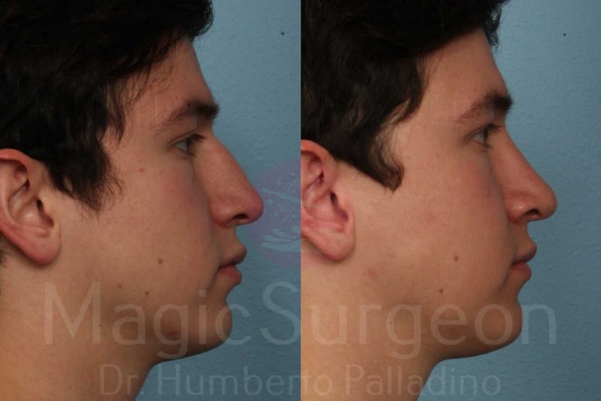 Rhinoplasty Before & After Gallery - Patient 133182411 - Image 5