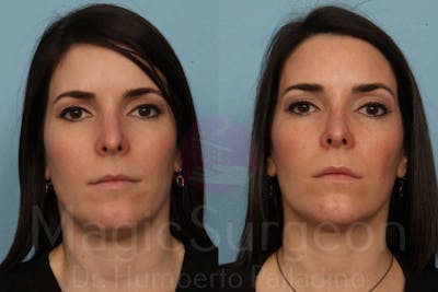 Rhinoplasty Before & After Gallery - Patient 133182413 - Image 1