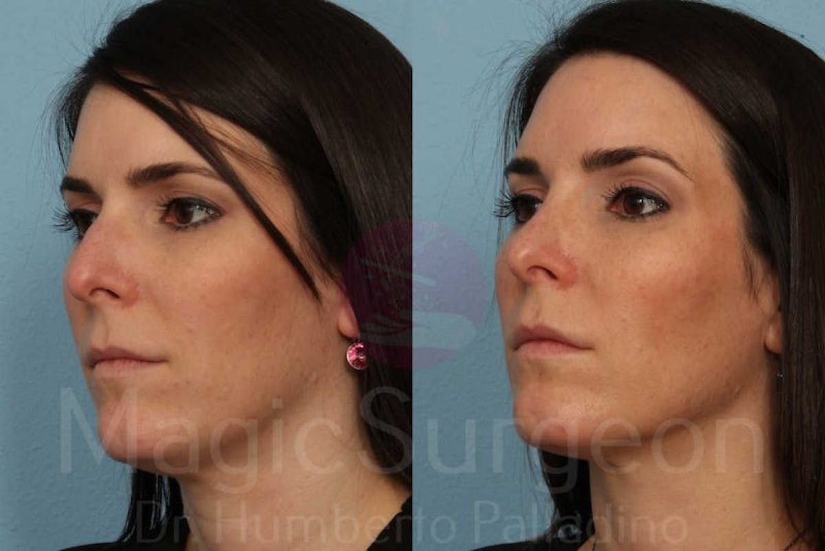 Rhinoplasty Before & After Gallery - Patient 133182413 - Image 2