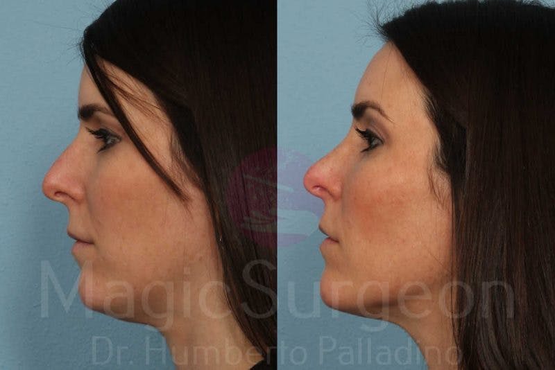 Rhinoplasty Before & After Gallery - Patient 133182413 - Image 3