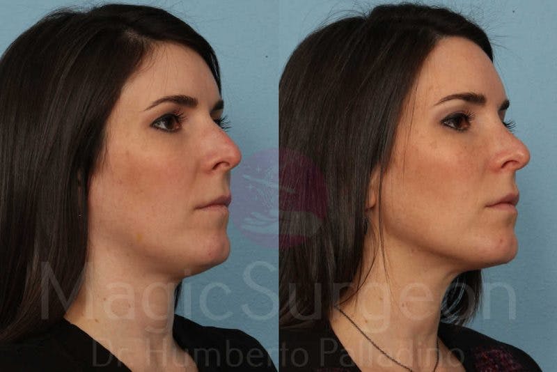 Rhinoplasty Before & After Gallery - Patient 133182413 - Image 4