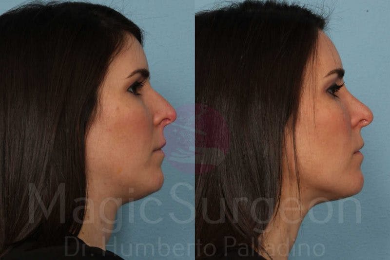 Rhinoplasty Before & After Gallery - Patient 133182413 - Image 5