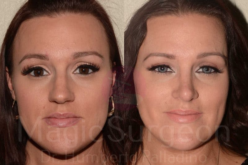 Rhinoplasty Before & After Gallery - Patient 133182414 - Image 1
