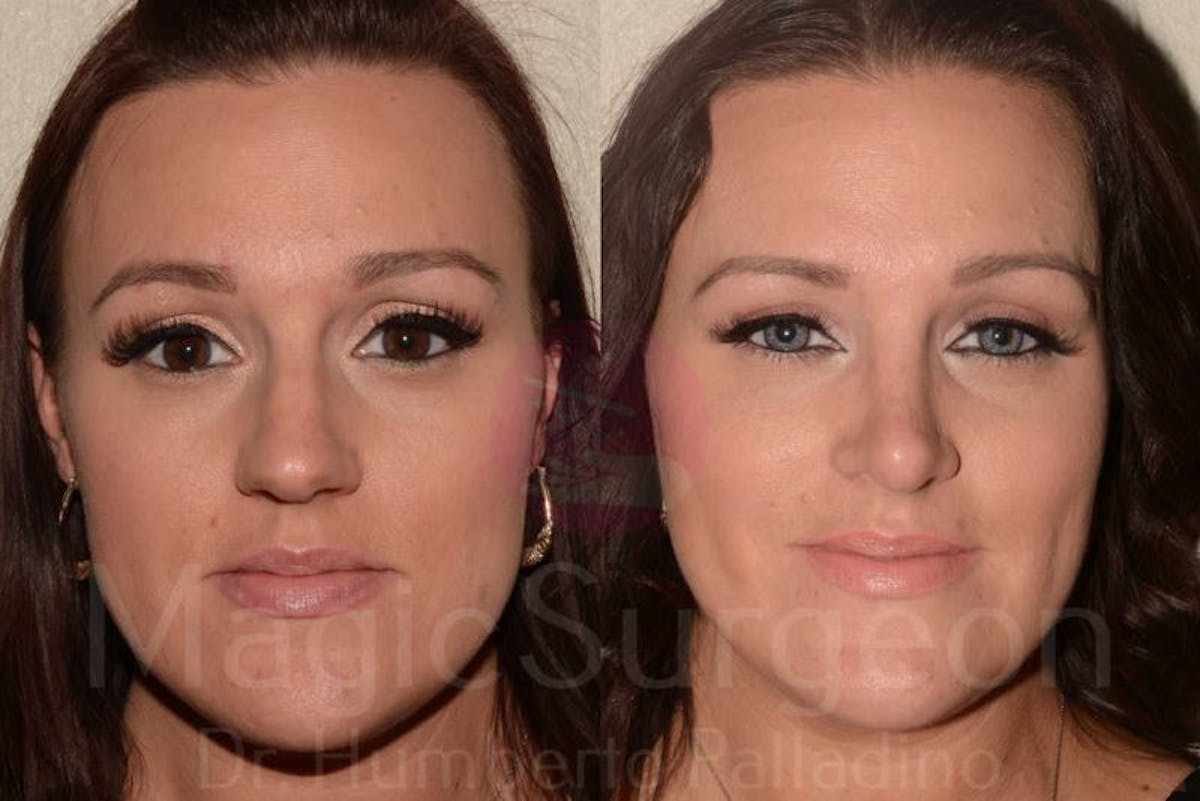 Rhinoplasty Before & After Gallery - Patient 133182414 - Image 1