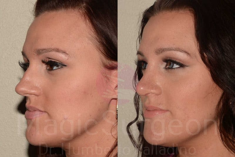 Rhinoplasty Before & After Gallery - Patient 133182414 - Image 2