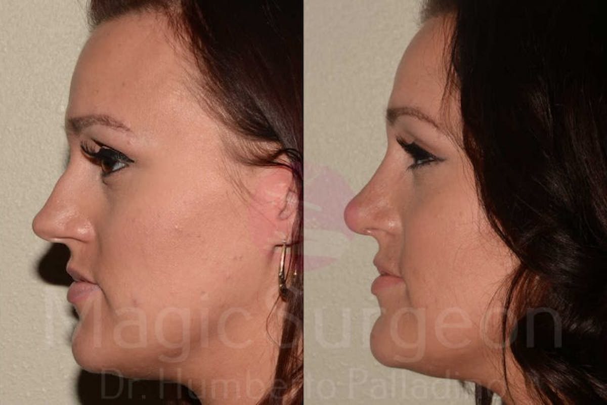 Rhinoplasty Before & After Gallery - Patient 133182414 - Image 3