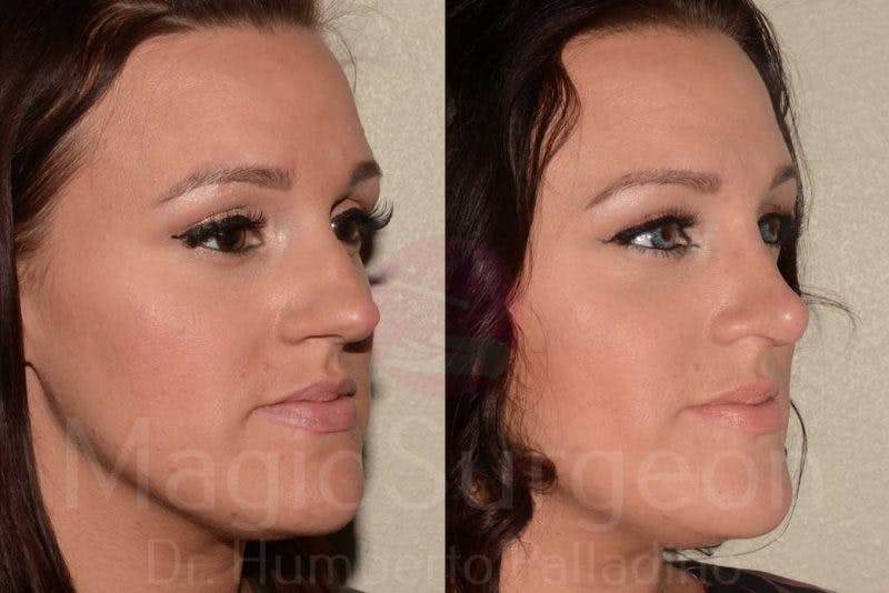 Rhinoplasty Before & After Gallery - Patient 133182414 - Image 4