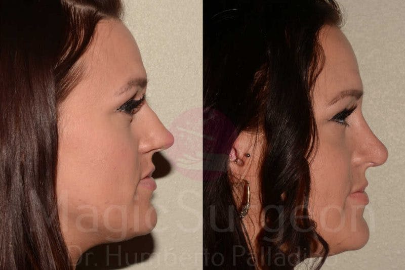 Rhinoplasty Before & After Gallery - Patient 133182414 - Image 5