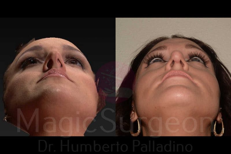 Rhinoplasty Before & After Gallery - Patient 133182414 - Image 6