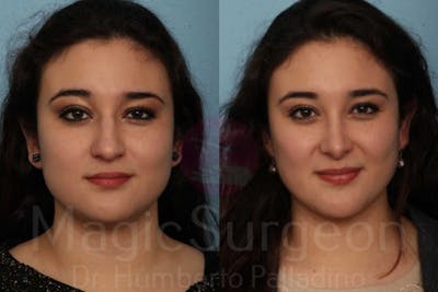Rhinoplasty Before & After Gallery - Patient 133182415 - Image 1