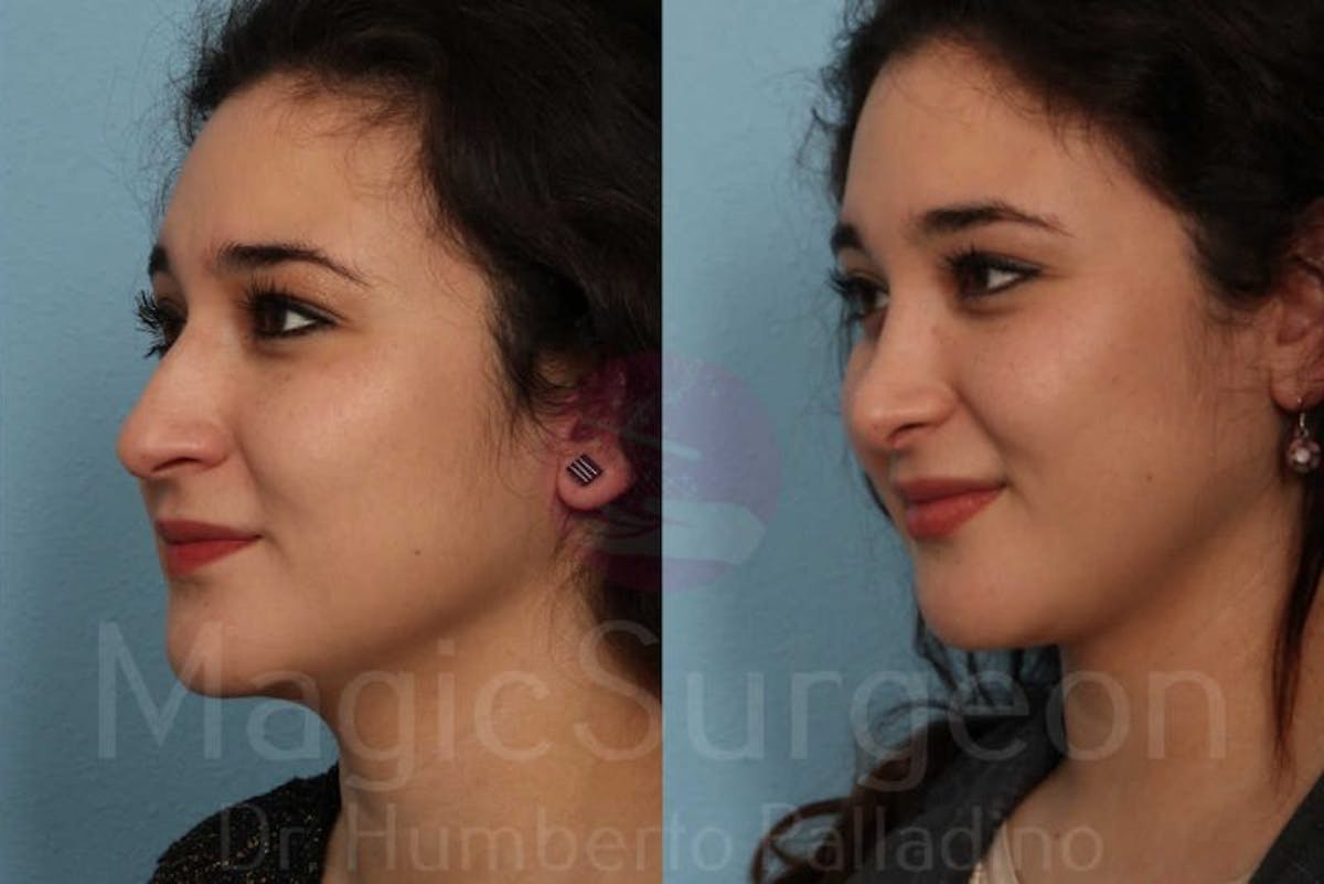 Rhinoplasty Before & After Gallery - Patient 133182415 - Image 2