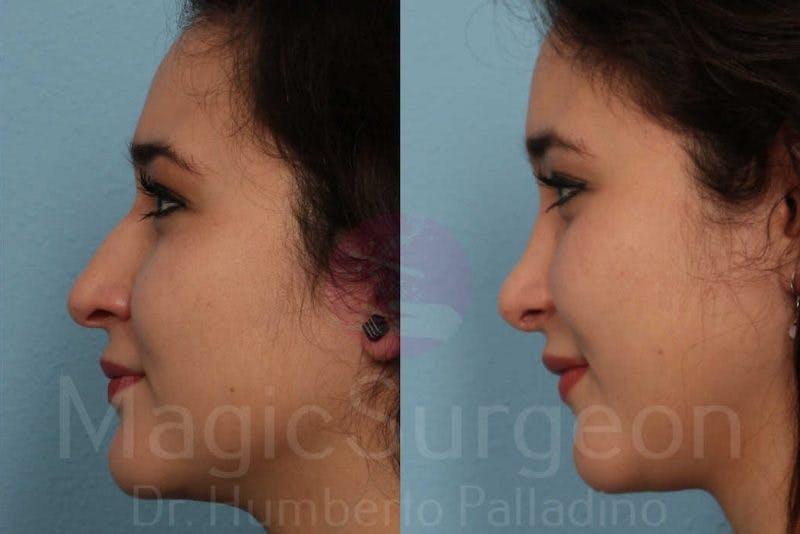 Rhinoplasty Before & After Gallery - Patient 133182415 - Image 3