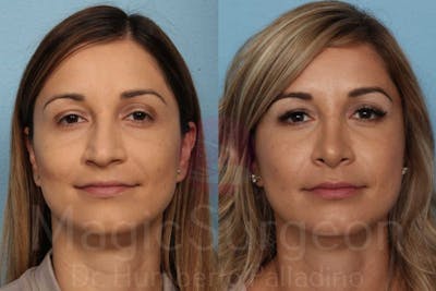 Rhinoplasty Before & After Gallery - Patient 133182418 - Image 1