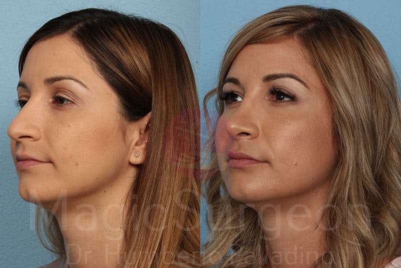 Rhinoplasty Before & After Gallery - Patient 133182418 - Image 2