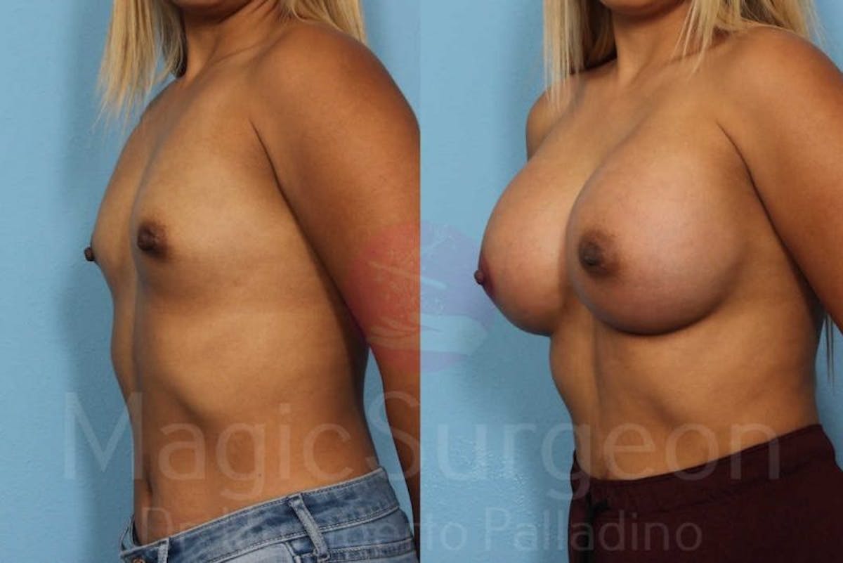 Breast Augmentation Before & After Gallery - Patient 133182417 - Image 2