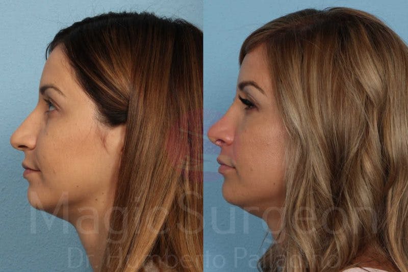 Rhinoplasty Before & After Gallery - Patient 133182418 - Image 3