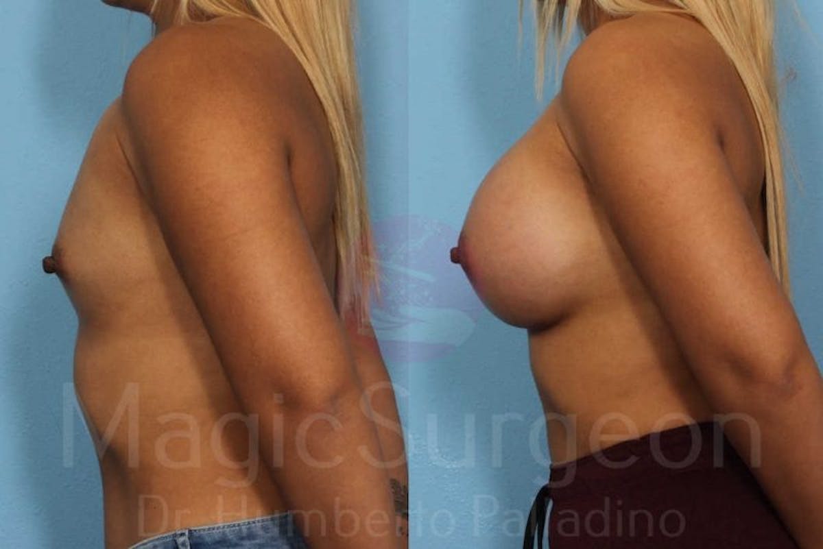 Breast Augmentation Before & After Gallery - Patient 133182417 - Image 3