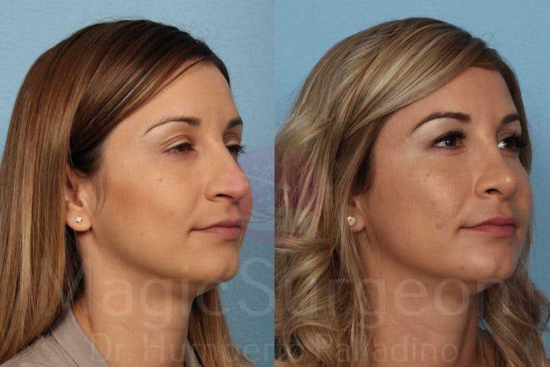 Rhinoplasty Before & After Gallery - Patient 133182418 - Image 4