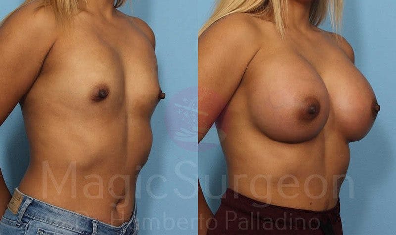 Breast Augmentation Before & After Gallery - Patient 133182417 - Image 4