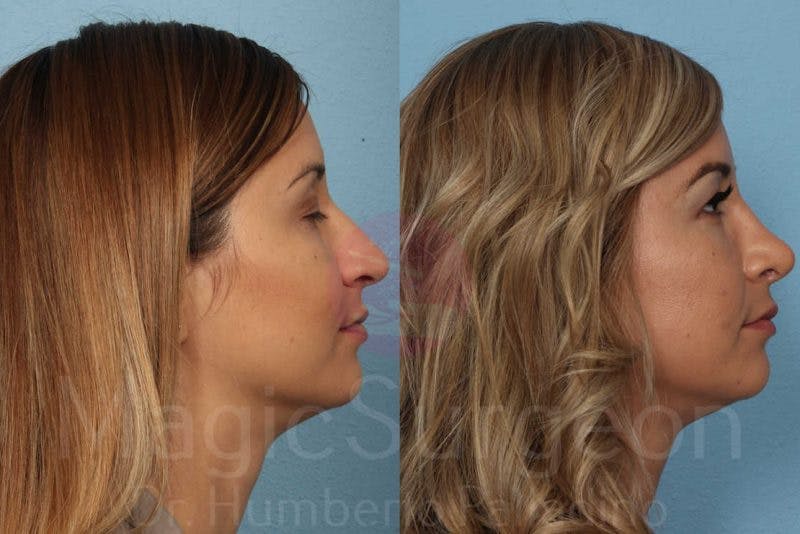 Rhinoplasty Before & After Gallery - Patient 133182418 - Image 5