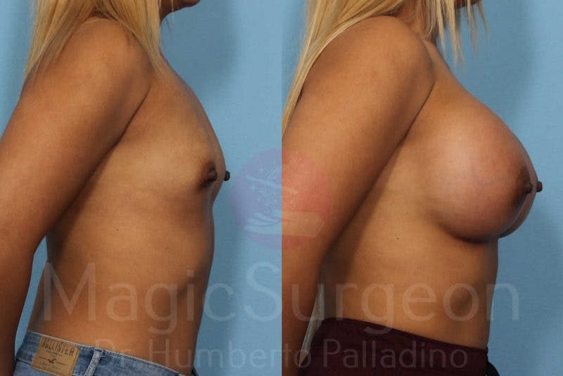 Breast Augmentation Before & After Gallery - Patient 133182417 - Image 5