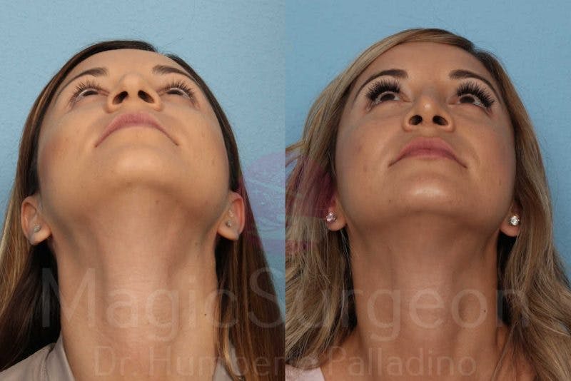 Rhinoplasty Before & After Gallery - Patient 133182418 - Image 6