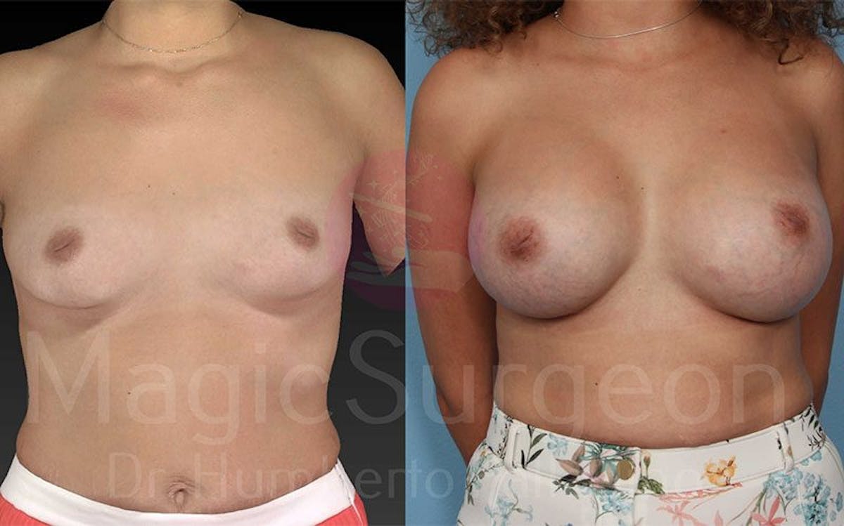 Breast Augmentation Before & After Gallery - Patient 133182421 - Image 1