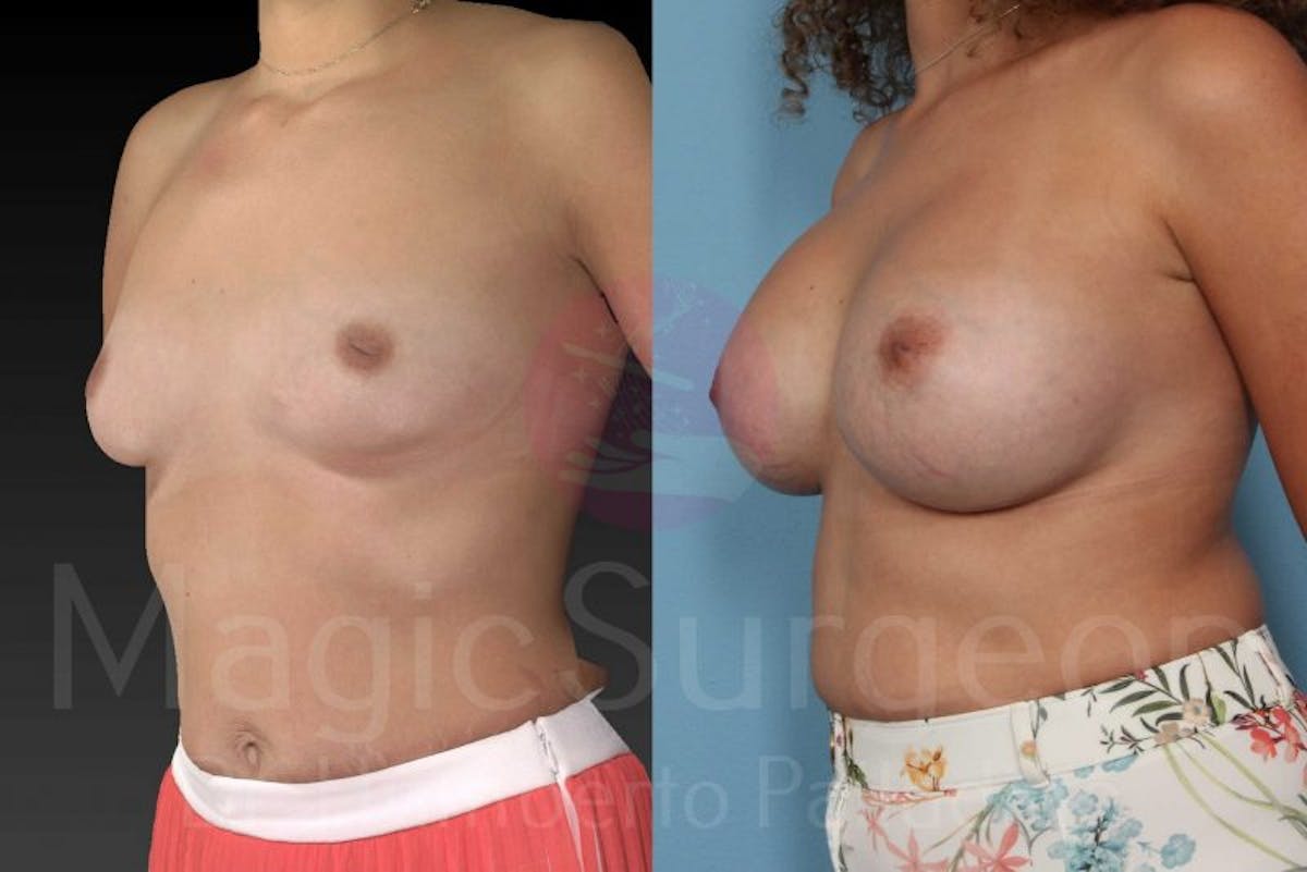 Breast Augmentation Before & After Gallery - Patient 133182421 - Image 2