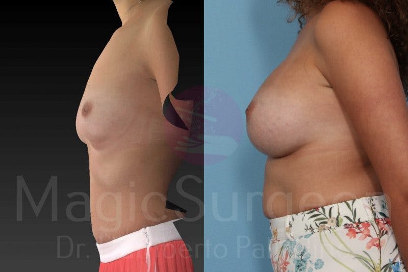 Breast Augmentation Before & After Gallery - Patient 133182421 - Image 3