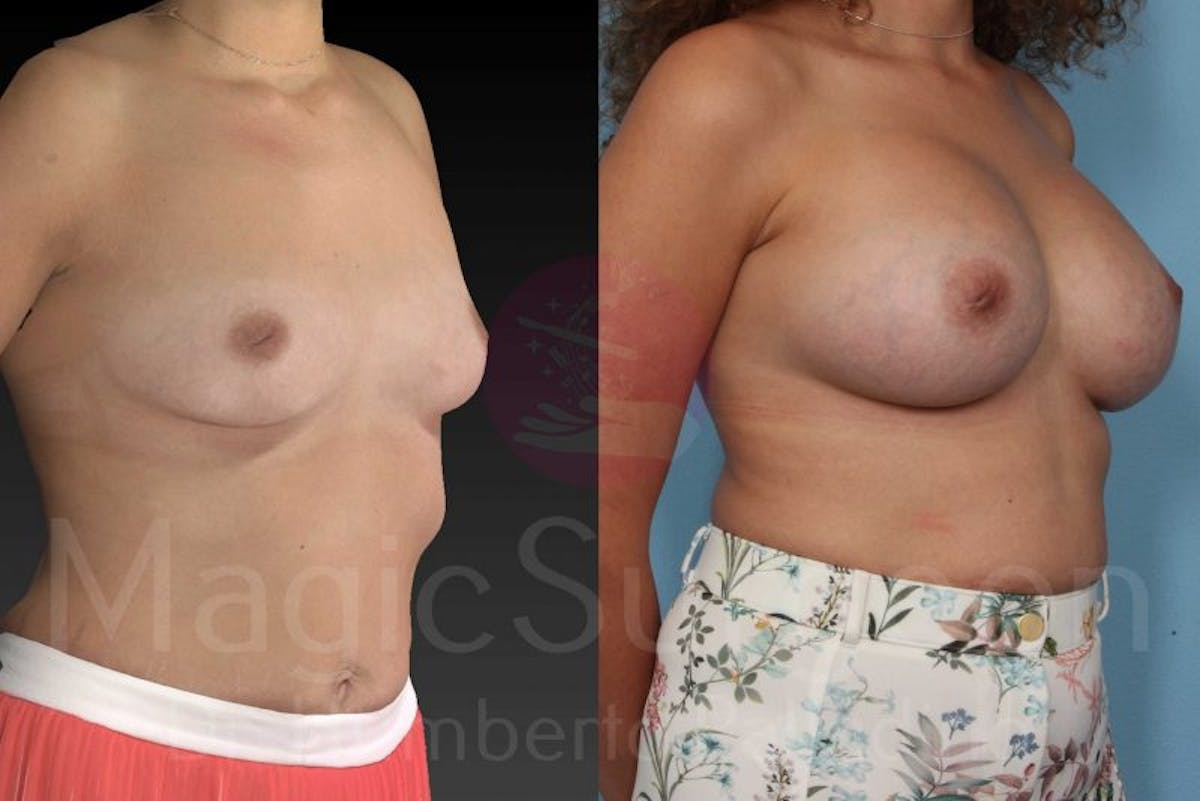 Breast Augmentation Before & After Gallery - Patient 133182421 - Image 4
