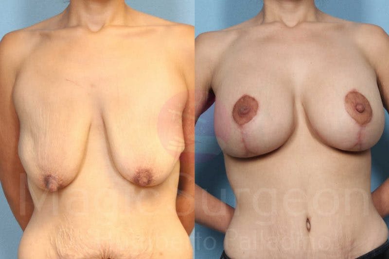 Breast Lift Before & After Gallery - Patient 133182422 - Image 1