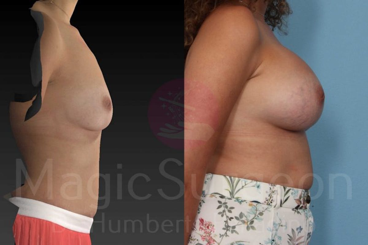 Breast Augmentation Before & After Gallery - Patient 133182421 - Image 5