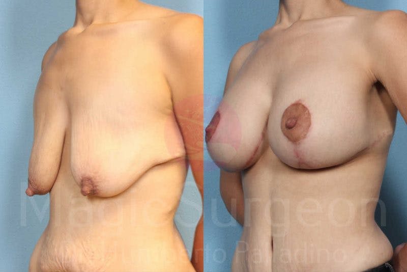 Breast Lift Before & After Gallery - Patient 133182422 - Image 2