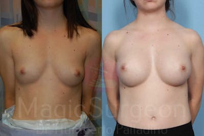 Breast Augmentation Before & After Gallery - Patient 133182424 - Image 1