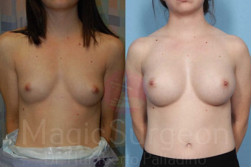 Breast Augmentation Before & After Gallery - Patient 133182424 - Image 1